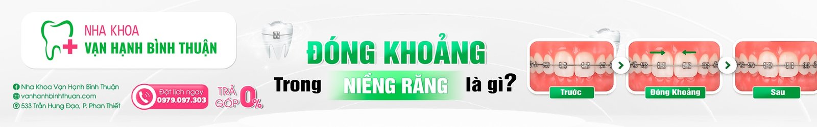 Đóng khoảng trong niềng răng là gì? Thời gian, phương pháp và các giai đoạn